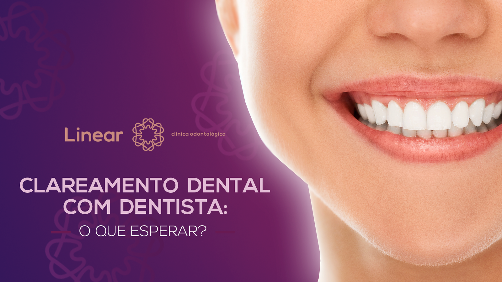 Clareamento dental