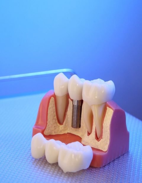 implantodontia - Dentista